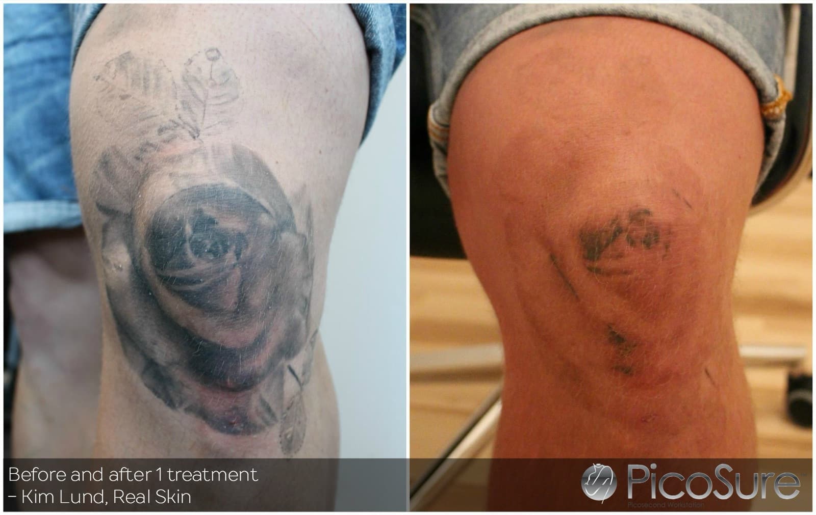 Før og efter 1 behandling, tatovering på overarm