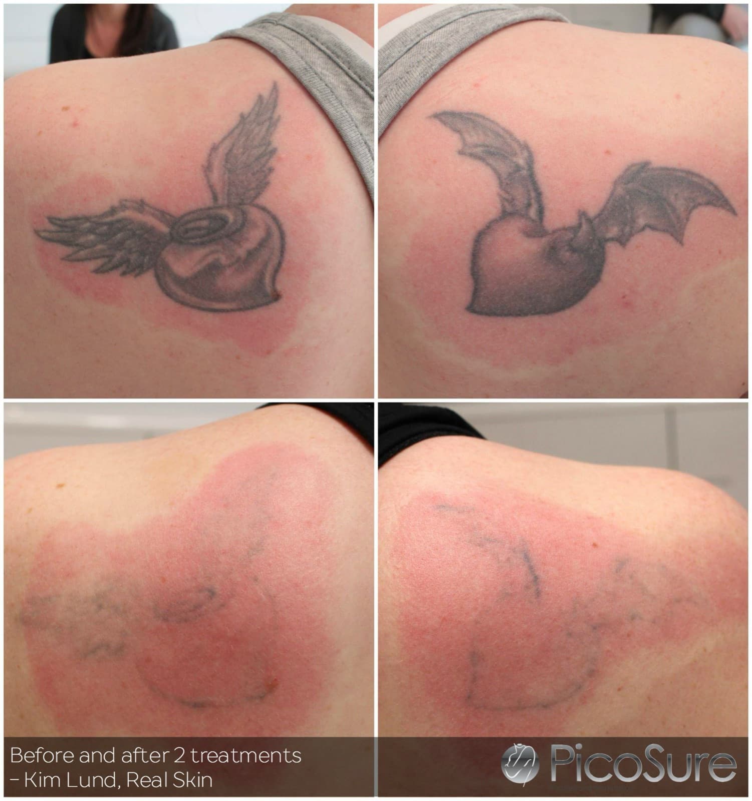 Før og efter 2 behandlinger, tatovering på ryggen