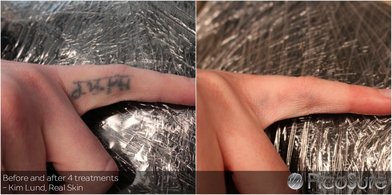 Før og efter 4 behandlinger, tatovering på finger