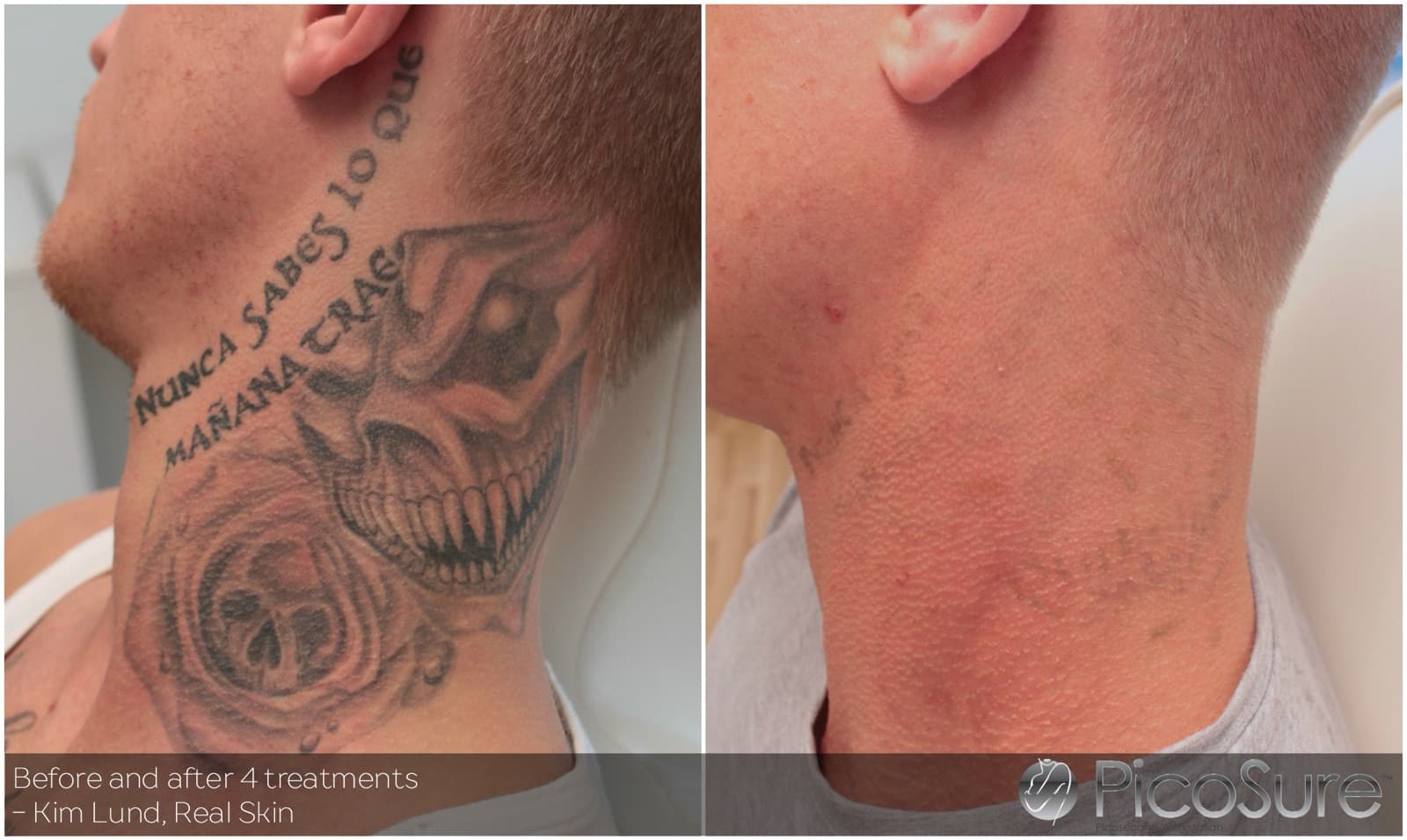 Før og efter 4 behandlinger, tatovering på hals fjernet