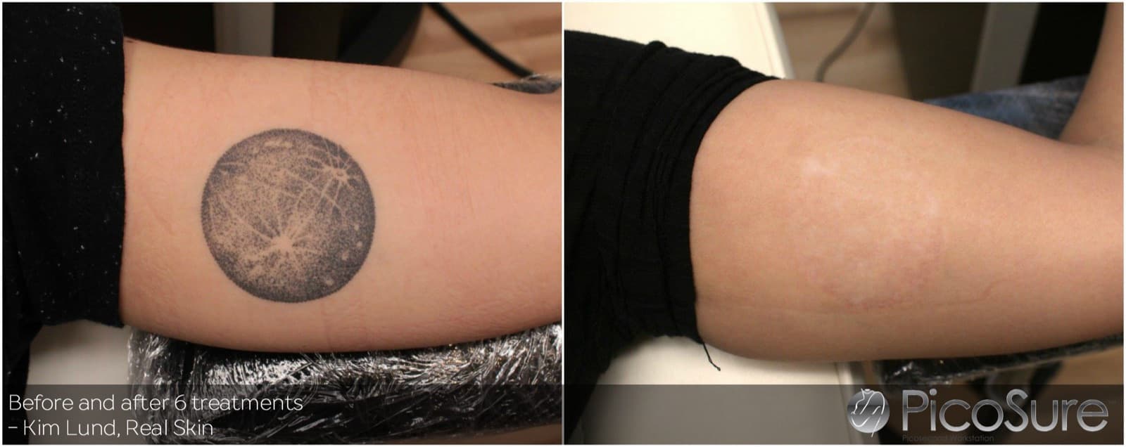 Før og efter 6 behandlinger, tatovering på inderside af overarm