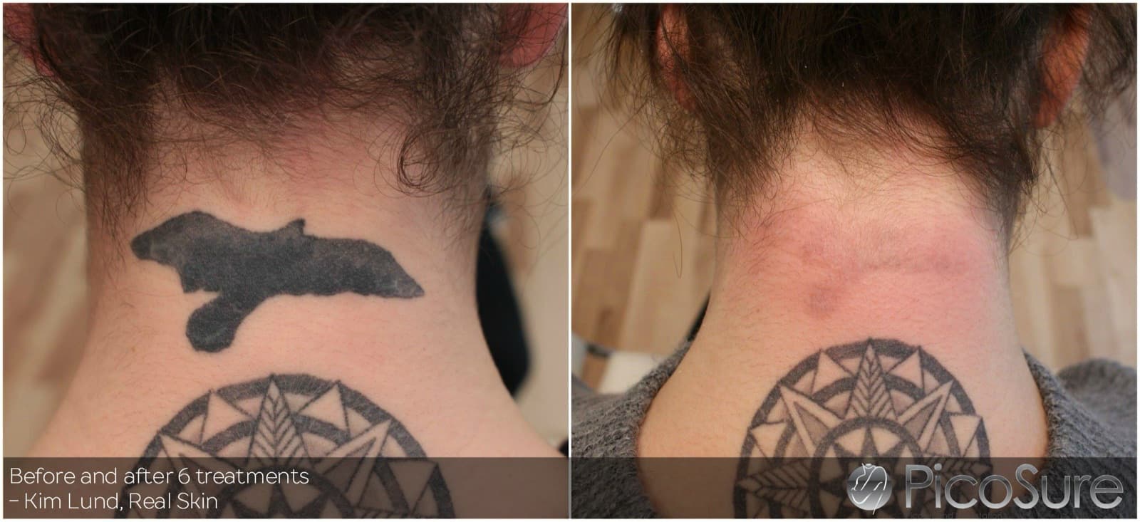 Før og efter 6 behandlinger, sort tatovering i nakken fjernet