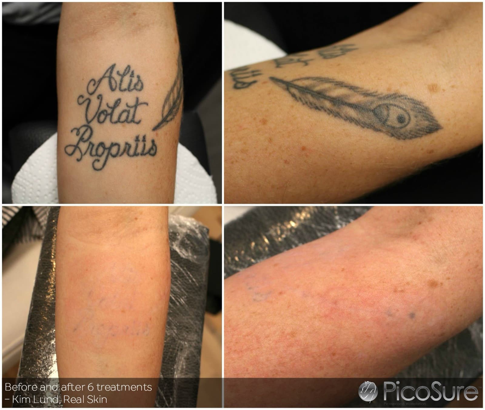Før og efter 6 behandlinger, tatovering på underarm