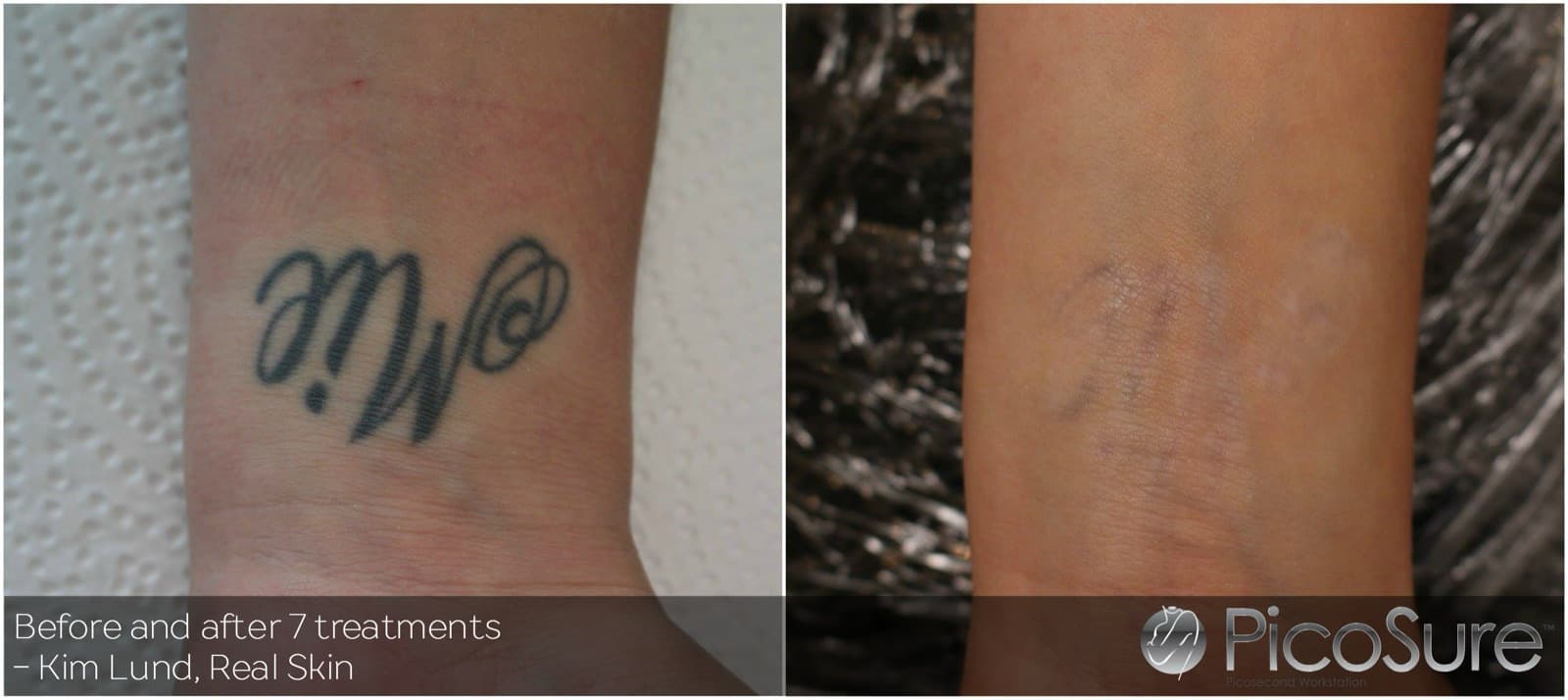 Før og efter 7 behandlinger, tatovering på håndled